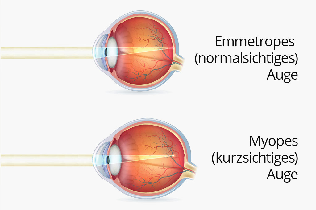 Myopiemanagement, gegen Kurzsichtigkeit, gegen Augenerkrankungen, Kurzsichtigkeit, Optometrist